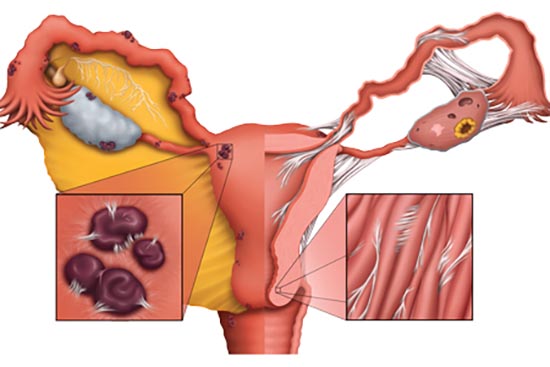 什么是子宫内膜异位症形成的原因